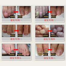 Fungal Nail Treatment Essence Nail and Foot Whitening Toe Nail Fungus Removal Feet Care Nail ILML